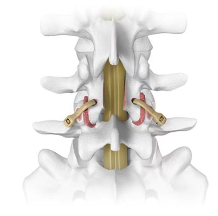 Spinal Elements® to Feature the Karma®, An Aging Spine, Metal-Free Fixation Solution, at Upcoming 38th Annual Meeting of the North American Spine Society