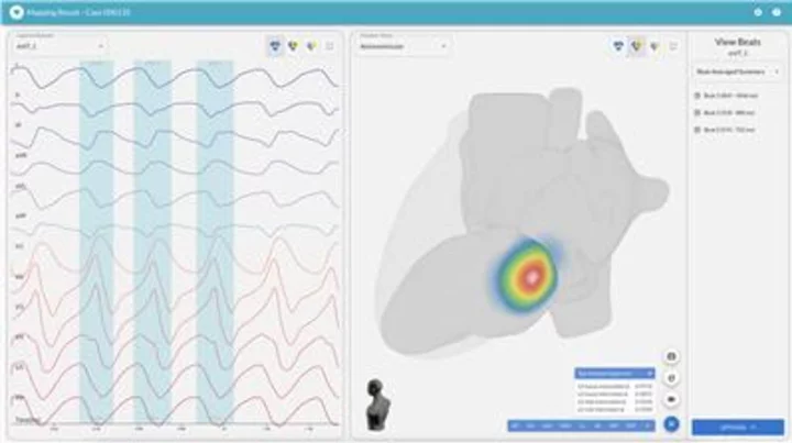 Vektor Medical Unveils Enhanced vMap Technology for Accurate, Non-invasive Mapping of Cardiac Arrhythmias