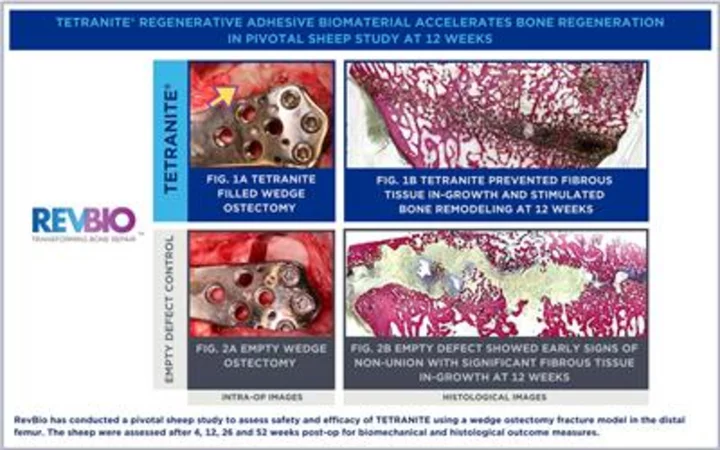 RevBio Awarded a $3.4 Million NIH Grant for Its Novel Regenerative Bone Adhesive to Treat Complex Fractures
